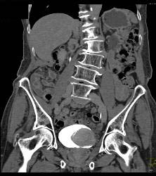 Bladder Cancer in Multiple Phases - CTisus CT Scan