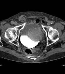 Bladder Cancer in Multiple Phases - CTisus CT Scan