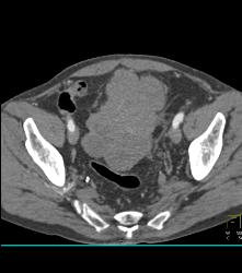 Sarcoma Arises Off the Bladder - CTisus CT Scan