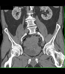 Sarcoma Arises Off the Bladder - CTisus CT Scan