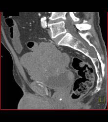 Sarcoma Arises Off the Bladder - CTisus CT Scan