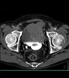 Sarcoma Arises Off the Bladder - CTisus CT Scan