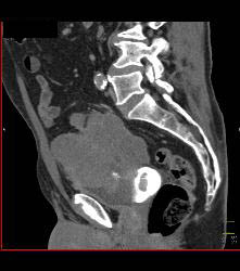 Sarcoma Arises Off the Bladder - CTisus CT Scan