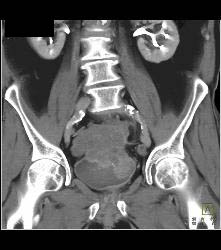 Sarcoma Arises Off the Bladder - CTisus CT Scan