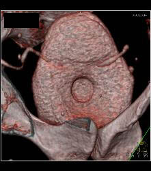 Bladder Cancer At Base - CTisus CT Scan