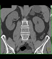 Bladder Cancer At Base - CTisus CT Scan