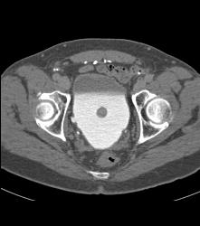 Bladder Cancer At Base - CTisus CT Scan