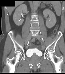 Bladder Cancer At Base - CTisus CT Scan