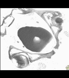 Bladder Cancer At Base - CTisus CT Scan