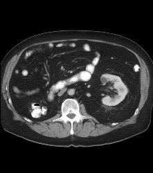 Cystic Lesion Off Prostate - CTisus CT Scan