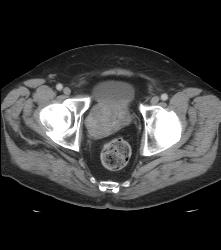 Cystic Lesion Off Prostate - CTisus CT Scan