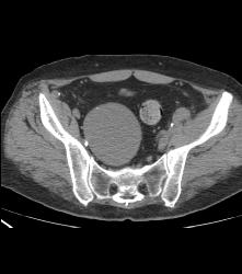 Cystic Lesion Off Prostate - CTisus CT Scan