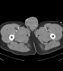 Scrotal Trauma - CTisus CT Scan