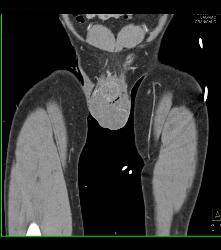 Scrotal Trauma - CTisus CT Scan