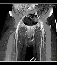 Scrotal Trauma - CTisus CT Scan