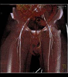 Scrotal Trauma - CTisus CT Scan