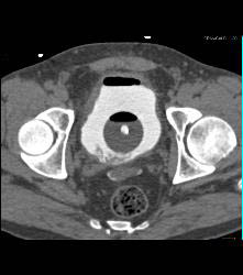 CT Cystogram With Leak - CTisus CT Scan