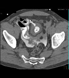 CT Cystogram With Leak - CTisus CT Scan