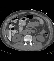 CT Cystogram With Leak - CTisus CT Scan