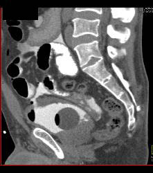 CT Cystogram With Leak - CTisus CT Scan