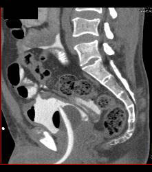 CT Cystogram With Leak - CTisus CT Scan