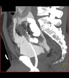 CT Cystogram With Leak - CTisus CT Scan