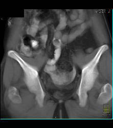 CT Cystogram With Leak - CTisus CT Scan