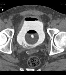 CT Cystogram With Leak - CTisus CT Scan