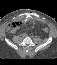 CT Cystogram With Leak - CTisus CT Scan