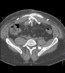 CT Cystogram With Leak - CTisus CT Scan