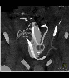 CT Cystogram With Leak - CTisus CT Scan