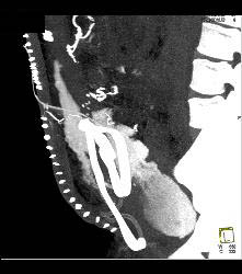 CT Cystogram With Leak - CTisus CT Scan