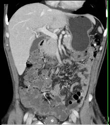 Sarcoma Invades Pelvic Bones- See Full Sequence - CTisus CT Scan