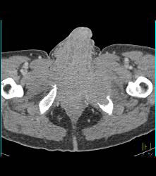 Sarcoma Invades Pelvic Bones- See Full Sequence - CTisus CT Scan