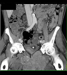 Sarcoma Invades Pelvic Bones- See Full Sequence - CTisus CT Scan