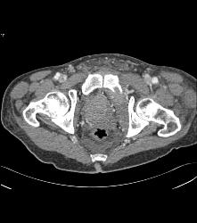 Sarcoma Invades Pelvic Bones- See Full Sequence - CTisus CT Scan