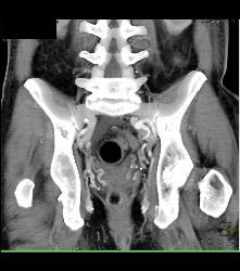 Sarcoma Invades Pelvic Bones- See Full Sequence - CTisus CT Scan