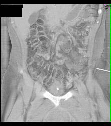 Sarcoma Invades Pelvic Bones- See Full Sequence - CTisus CT Scan