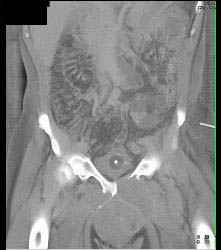 Sarcoma Invades Pelvic Bones- See Full Sequence - CTisus CT Scan