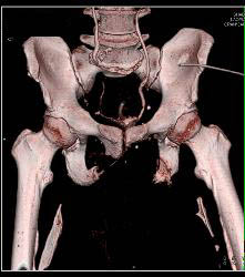 Sarcoma Invades Pelvic Bones- See Full Sequence - CTisus CT Scan