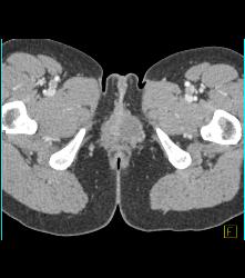 Sarcoma Invades Pelvic Bones- See Full Sequence - CTisus CT Scan