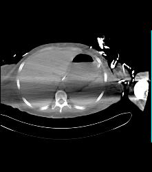 Contrast Extravasation in Arm - CTisus CT Scan