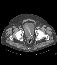 Jet From Ureter - CTisus CT Scan