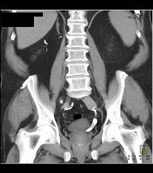 Jet From Ureter - CTisus CT Scan