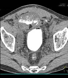 Bladder Perforation on CT Cystogram - CTisus CT Scan