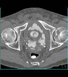 Bladder Perforation on CT Cystogram - CTisus CT Scan