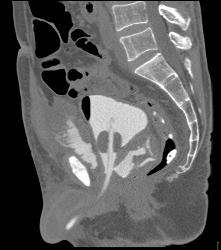 Bladder Perforation on CT Cystogram - CTisus CT Scan