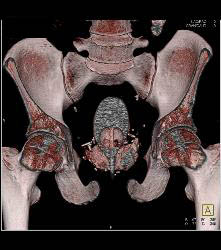 Bladder Perforation on CT Cystogram - CTisus CT Scan