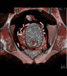 Bladder Perforation on CT Cystogram - CTisus CT Scan