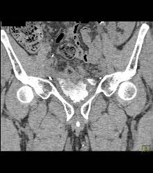 Bladder Perforation on CT Cystogram - CTisus CT Scan